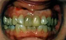 Crowns Before & After
