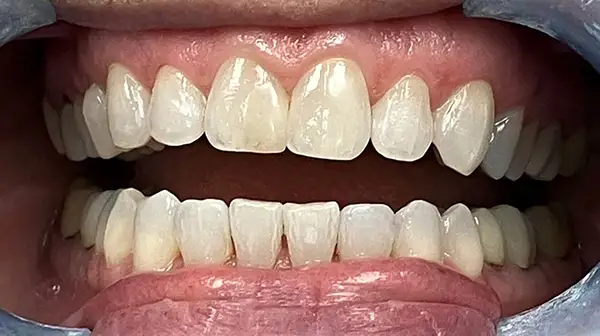Invisalign Before & After Smile Gallery