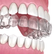 Clear Aligners