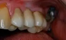 Bridges Before & After Smile Gallery 