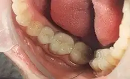 Crowns Before & After