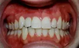 Dental Implants Before & After