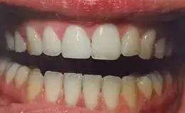 Bonding Before & After Smile Gallery