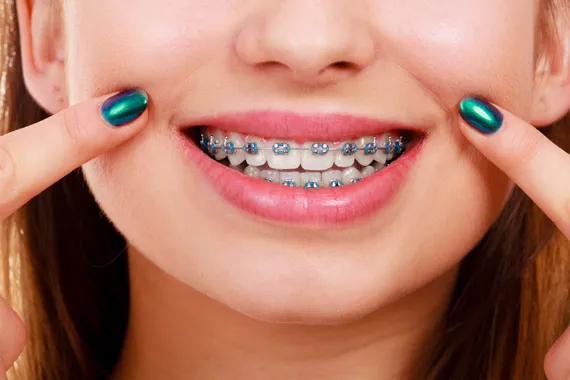 Person smiling with visibly misaligned teeth, representing orthodontic needs.