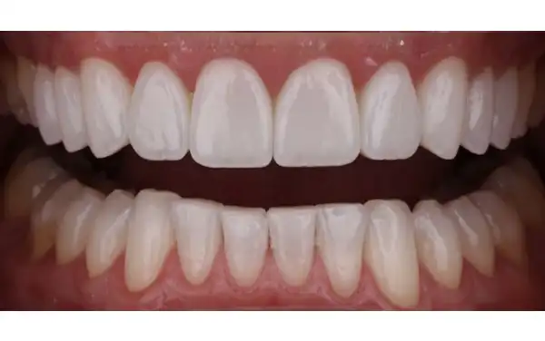 Before and After