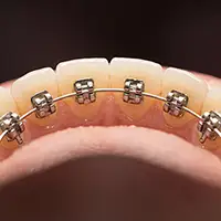 Lingual Braces