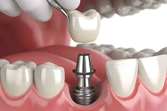 What is an implant restoration? 