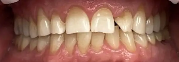 Invisalign Before & After Smile Gallery