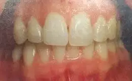 Whitening Before & After Smile Gallery