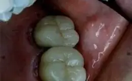 Crowns Before & After