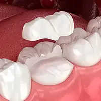 Onlays