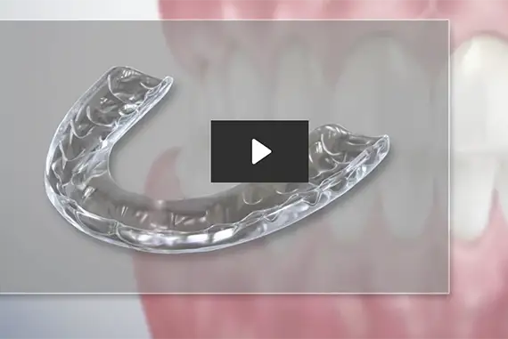 Custom night guard designed to protect teeth from grinding.