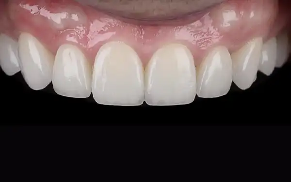 Before and After