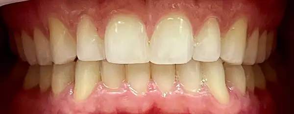 Invisalign Before & After Smile Gallery
