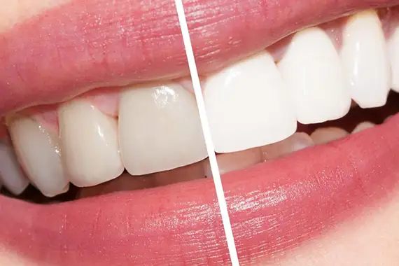 Teeth whitening
