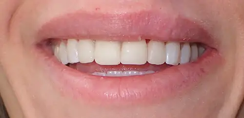 Temporary Smile and Bite